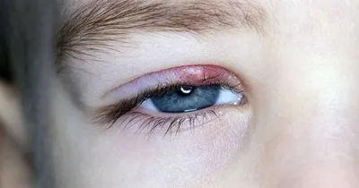 Не болезнь, а проклятие: как быстро вылечить ячмень на глазу | DOCTORPITER