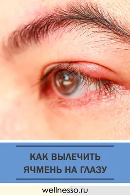 Ячмень на глазу: лечение на верхнем и нижнем веке, причины появления