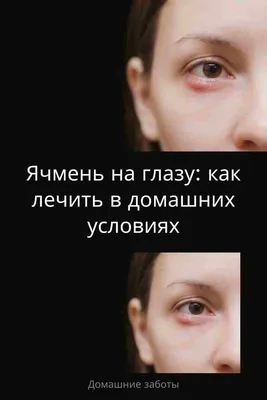 Ячмень: лекарства, используемые при лечении - МИС Аптека 9-1-1
