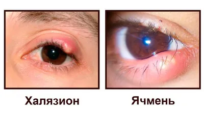 Как лечить ячмень на глазу быстро в домашних условиях? - Качественный  Казахстан