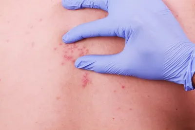 Болезнь черепицы Sympton вирус герпеса на человеческом теле Сыпь на коже и  волдырей на теле Стоковое Изображение - изображение насчитывающей сыпь,  иносказательных: 197929649