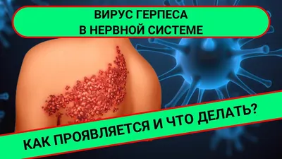 Все о герпесе на губах и коже лица: иммунолог рассказала, как быстро  вылечить герпес? | О здоровье: с медицинского на русский | Дзен