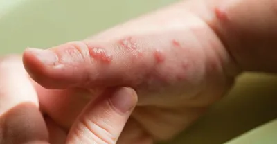 Герпес — симптомы и лечение | Блог Daily Medical