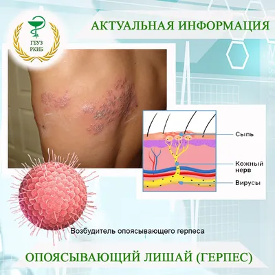 Дерматологические проявления вирусных инфекций. Часть 2