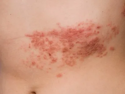 Инфицированная Кожей Вирус Herpes Zoster Вирус Герпеса На Теле Крапивница  Атопический Дерматит На Теле — стоковые фотографии и другие картинки  Опоясывающий лишай - iStock
