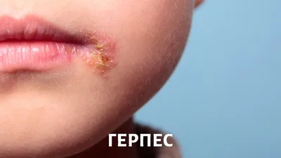 Оспа обезьян – это герпес, вызванный вакцинами против COVID-19 – фейк |  Inbusiness.kz