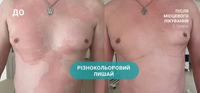 Как избавиться от стригущего лишая — блог медицинского центра ОН Клиник