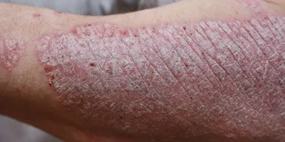 Каким бывает лишай у человека? Симптомы и лечение лишая у людей