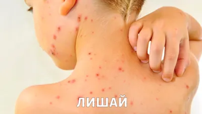 Стригущий лишай: признаки, профилактика и лечение | Здоровье ребенка |  Здоровье | Аргументы и Факты