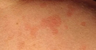 Инфицированная Кожей Вирус Herpes Zoster Вирус Герпеса На Теле Крапивница  Атопический Дерматит На Теле — стоковые фотографии и другие картинки  Опоясывающий лишай - iStock