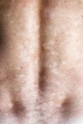 Розовый лишай Жибера: симптомы, диагностика и лечение в клинике Universum  Clinic