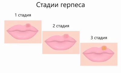 Лечение герпеса на губах в домашних условиях: чем мазать простуду на губах  дома
