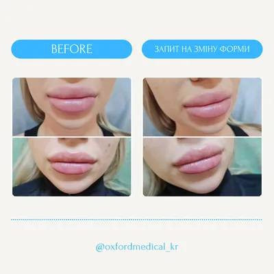 Увеличение губ филлером сколько держится? | Darmed-Clinic