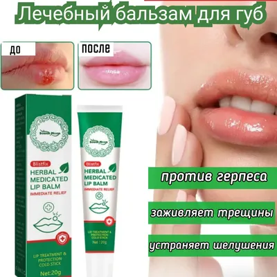 Увеличение и бьютификация губ. До и После (Фото)