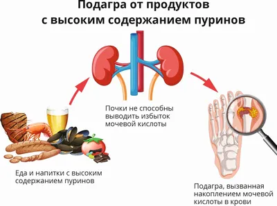 Подагра на руках [симптомы и лечение подагры суставов пальцев]