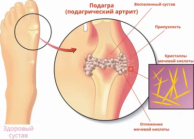 Массаж при лечении подагры | Массажный мир | Дзен