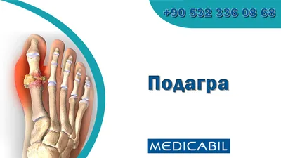 Подагра: что это за болезнь, признаки, причины, симптомы, диагностика,  лечение