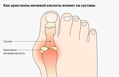 Названы первые симптомы развития подагры - Российская газета