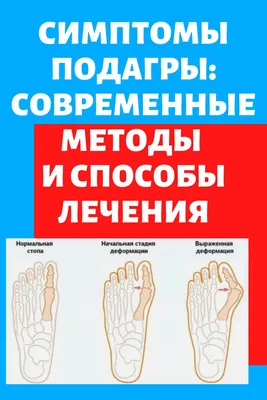 6 шт./кор. лечения подагры патч пальцев на руках и ногах, корректор для  большого пальца стопы облегчение боли медицинский пластырь для ног кости с  накатанной головкой корректор наклейки здравоохранения | AliExpress