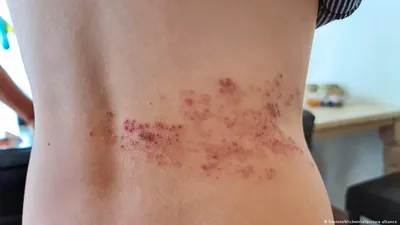 Опоясывающий лишай