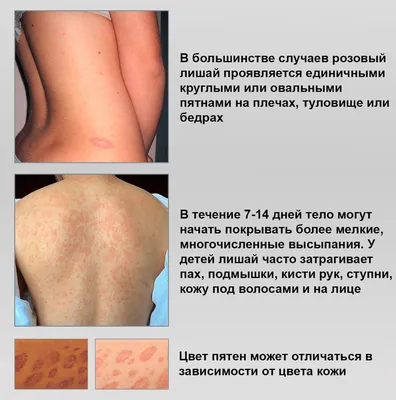Дерматомикоз (стригущий лишай): виды, симптомы и лечение