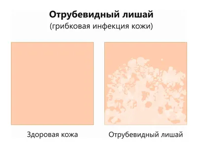 Опоясывающий лишай (опоясывающий герпес, herpes zoster): симптомы и  профилактика