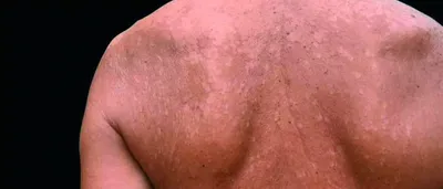 Лечение розового лишая (лишая Жибера) в Киеве — Derma.ua