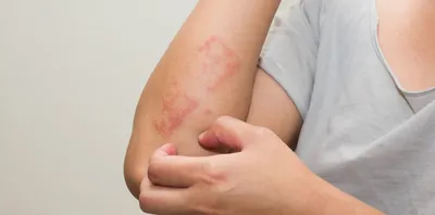 Лишай — разновидности заболевания и лечение | Evolutis Clinic | Дзен