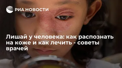 На коже появилось красное пятно с четкими границами. Наверное, это лишай? |  Ответ по теме Медицина