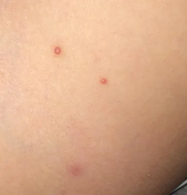 Моллюски на коже картинки фотографии
