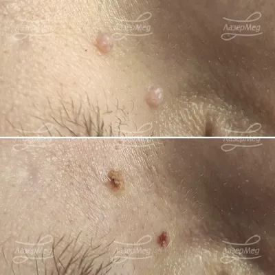 Контагиозный Моллюск Инфекция Бугоркисыпь На Коже Детей — стоковые  фотографии и другие картинки Болезни кожи - iStock