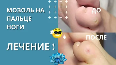 Как отличить мозоль от натоптыша. Чем мозоли на ногах отличаются от  натоптышей? | Клиника Гевди | Дзен
