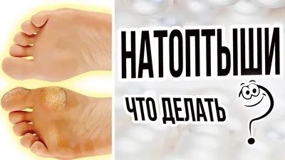 Как отличить мозоль от натоптыша. Чем мозоли на ногах отличаются от  натоптышей? | Клиника Гевди | Дзен