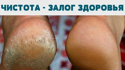 Как лечить мозоли и трещины - Клиника ТРИНИТИ (Москва)