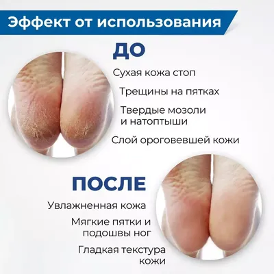 Трещины, натоптыши и мозоли на стопах причины и лечение?