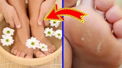 Как избавиться от натоптышей и сухих мозолей на ногах? Способы лечения