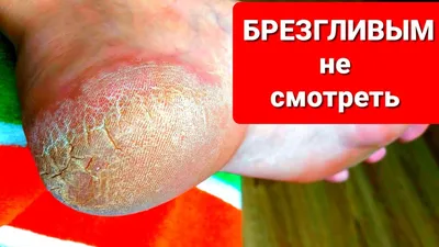 Как лечить мозоли и натоптыши у детей: на пятке, ступне, пальцах ног