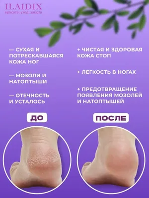 ILAIDIX Косметика для ног от мозолей, натоптышей и трещин на пятках