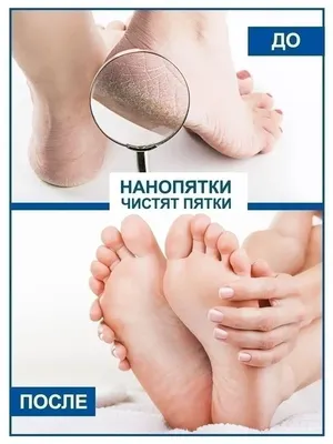 Силиконовые дышащие насадки на пальцы ног, защитные насадки на пальцы ног  против трения, предотвращающие мозоли, защитные насадки на пальцы ног, уход  за ногами | AliExpress