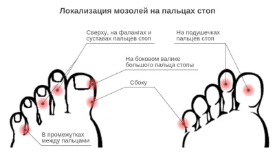 Удаление лазером сухих и стержневых мозолей на ногах в клинике  инновационных медицинских технологий «Градиент» в Москве