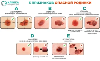 Удаление папиллом - цена в Новосибирске | Удаление фотеком в клинике  «Диагност»