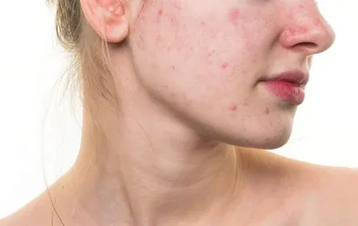 Казалось, эти прыщи никогда не закончатся»: сибирячка рассказала, как  смогла победить акне без единой таблетки и косметологов - KP.RU