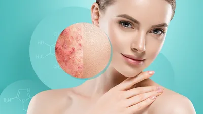 Как избавиться от подкожных прыщей на лице: причины и методы лечения
