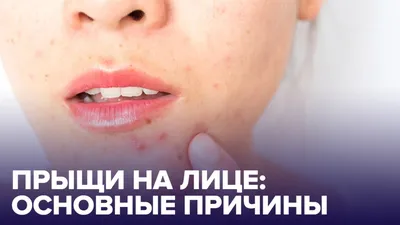 Прыщи на лице - причины, зоны, лечение. Как избавиться от прыщей, акне - 25  ноября 2020 - Sport24