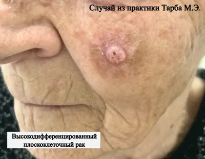 Небольшой прыщик на лице девушки оказался раком кожи, который чуть её не  убил