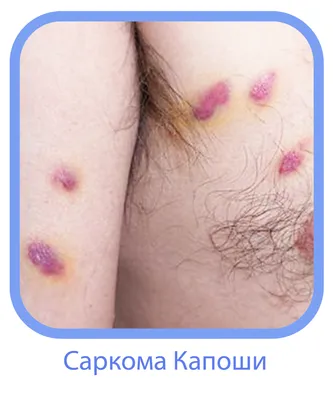 Хлои Кардашьян показала лицо после меланомы - фото | РБК Украина