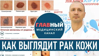 Рак кожи базальноклеточный, плоскоклеточный - прогнозы лечения