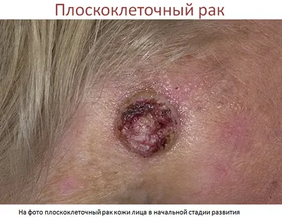 Рак кожи щеки | NEOPLASTY