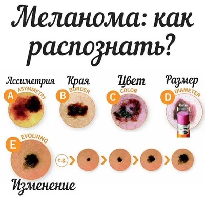 Профилактика рака кожи!