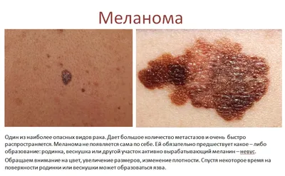 Первично-множественный рак кожи